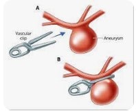 Best aneurysm clipping treatment in sarjapur road