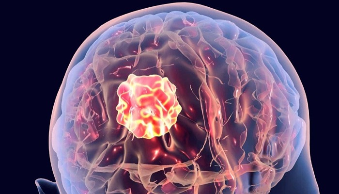 Brain Tumors: Early Warning Signs, Diagnosis & Modern Treatment Options