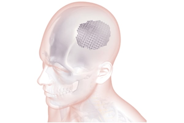 Cranioplasty