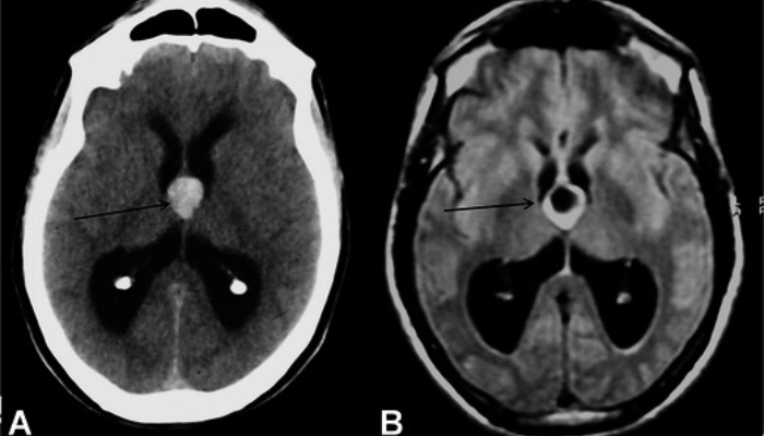 Decoding Hydrocephalus: Understanding, Diagnosis, and Treatment