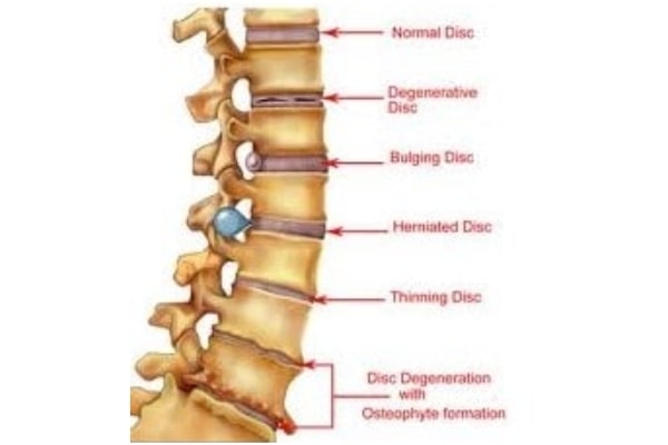 Best lumbar spinal treatment in sarjapur road