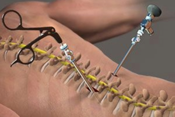 Lumbar Discectomy