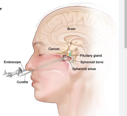 Best pituitary tumor surgery treatment in sarjapur road