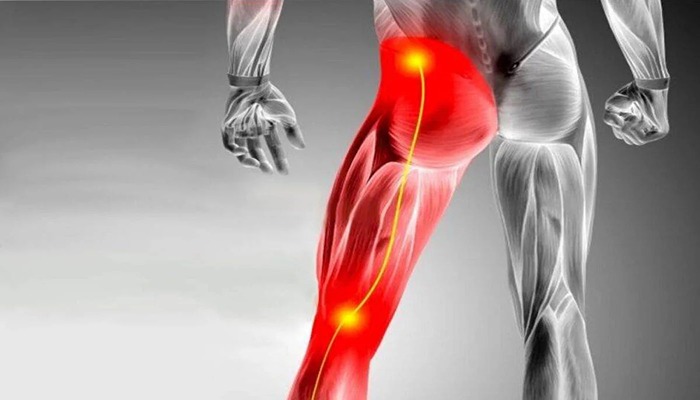 Sciatica Pain: Causes, Symptoms, Advanced Treatment & Long-Term Relief
